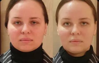 Facial contours appear more defined, skin texture looks smoother, and the overall face appears refreshed and more balanced.