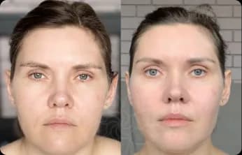 Facial contours are more sculpted, with improved symmetry and reduced puffiness. The skin appears smoother and looks rejuvenated.