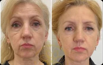 Wrinkles and fine lines are visibly reduced, especially around the eyes and mouth. The face appears lifted, with smoother skin texture and a more youthful, refreshed look.